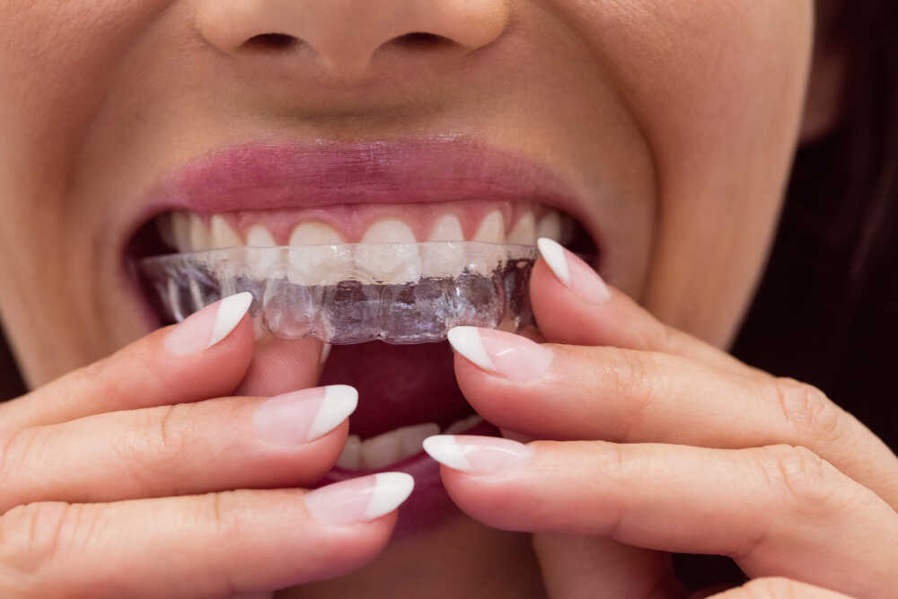 Pacjentka zakładka nakładki Invisalign na swoje zęby